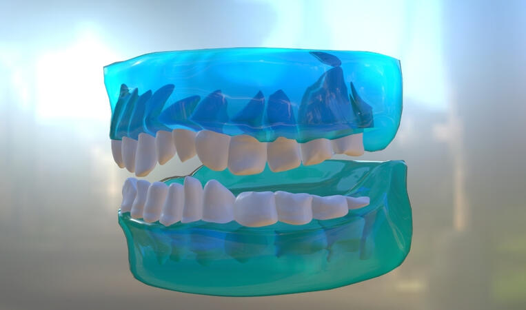 3D model denture